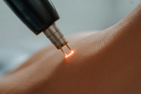 Лазерное удаление сосудистой сетки на лице: какой лазер выбрать и как проходит процедура